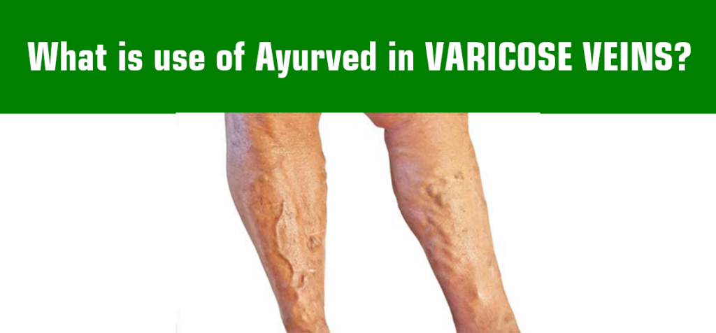 Ayurved in VARICOSE VEINS